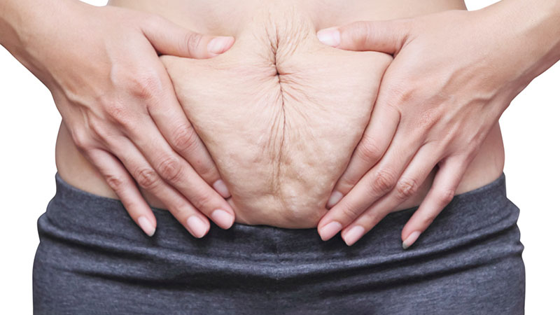 Stretch marks are commonly found near the breast, hips, arms, tummy and thighs. Stretch marks post-delivery can be treated naturally with oil treatment, aloe vera, honey, sugar, etc. because these items have antiseptic properties. Using lemon water, apricots and potato juice is also suggested becaus